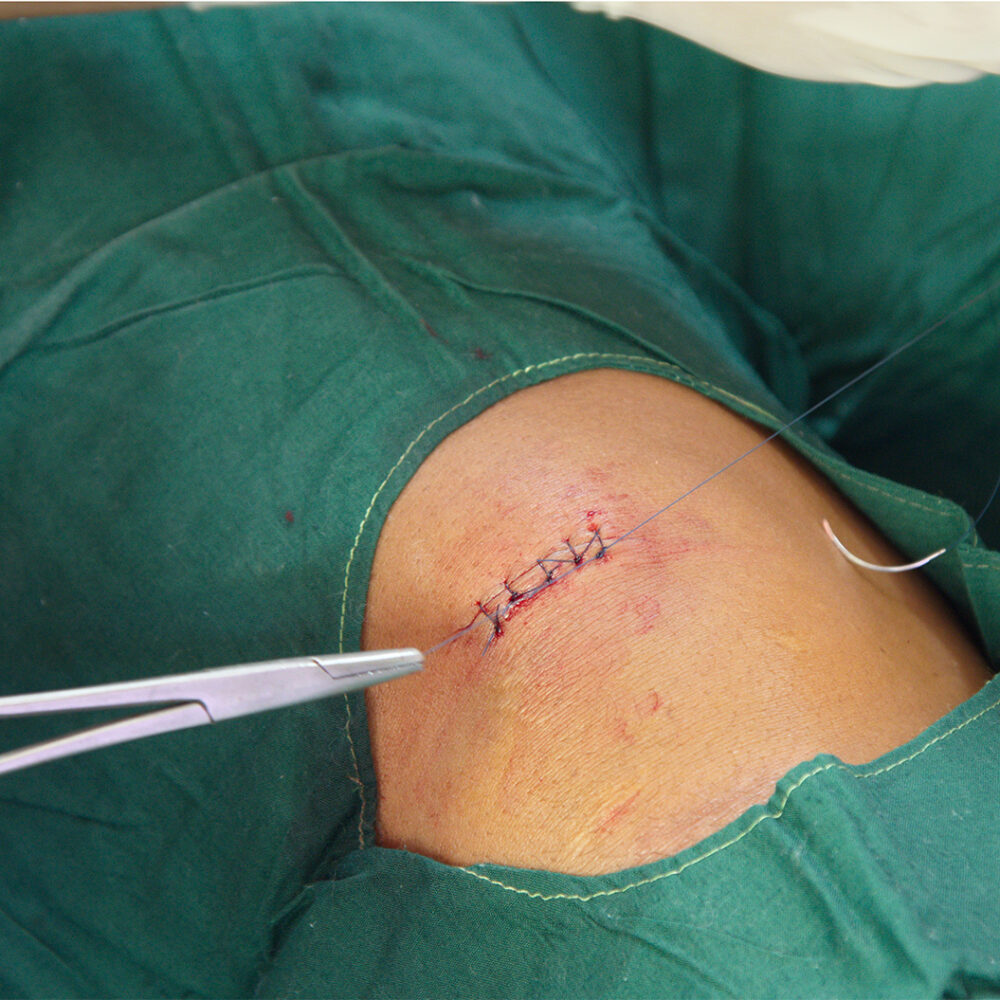 img-suturing